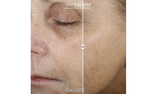 Unveiling the Secret to Radiant Skin: SkinBetter’s Even Tone Serum - Amethyst Skin Clinic