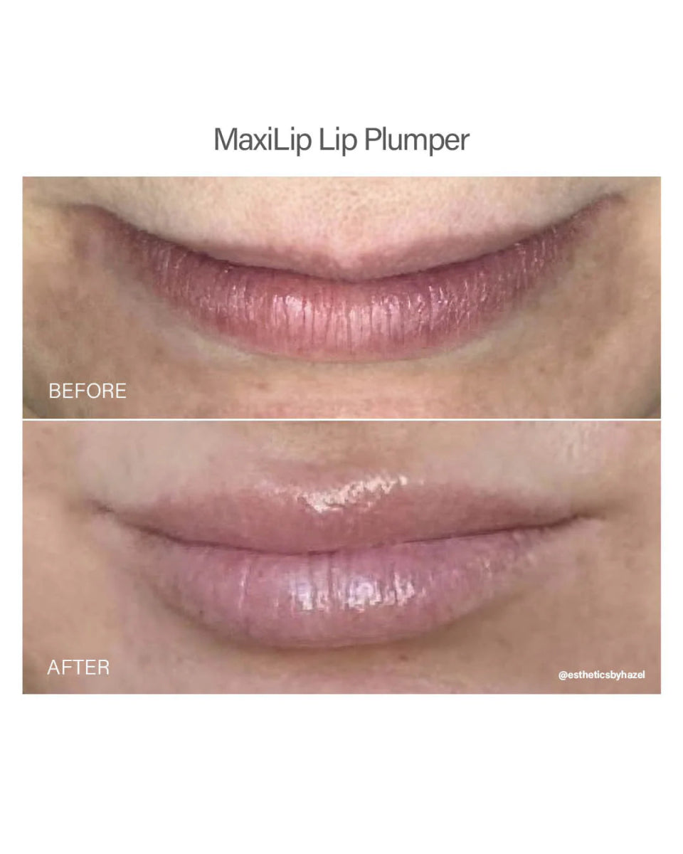 Maxilip Lip Plumper - Amethyst Skin Clinic