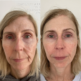 Youthplex Face Lift Toning Solution - Amethyst Skin Clinic