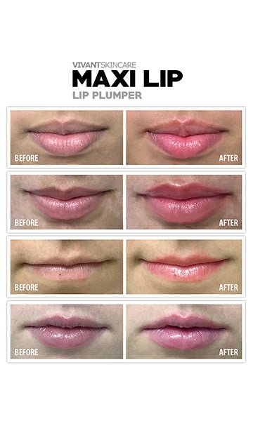 Maxilip Lip Plumper - Amethyst Skin Clinic
