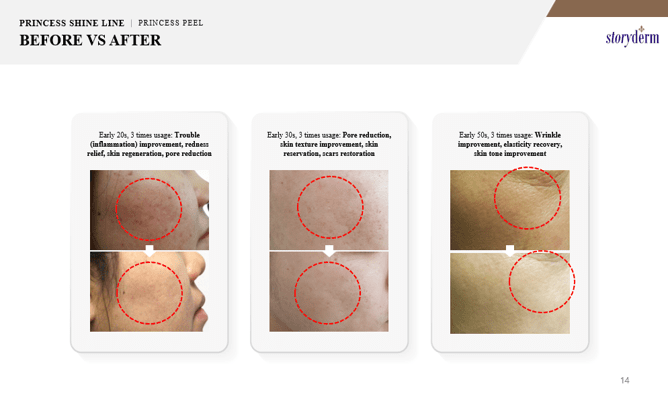 Storyderm's Princess Peel - A Korean Treatment - Amethyst Skin Clinic