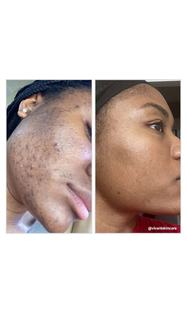 8% Mandelic Acid Serum - Amethyst Skin Clinic