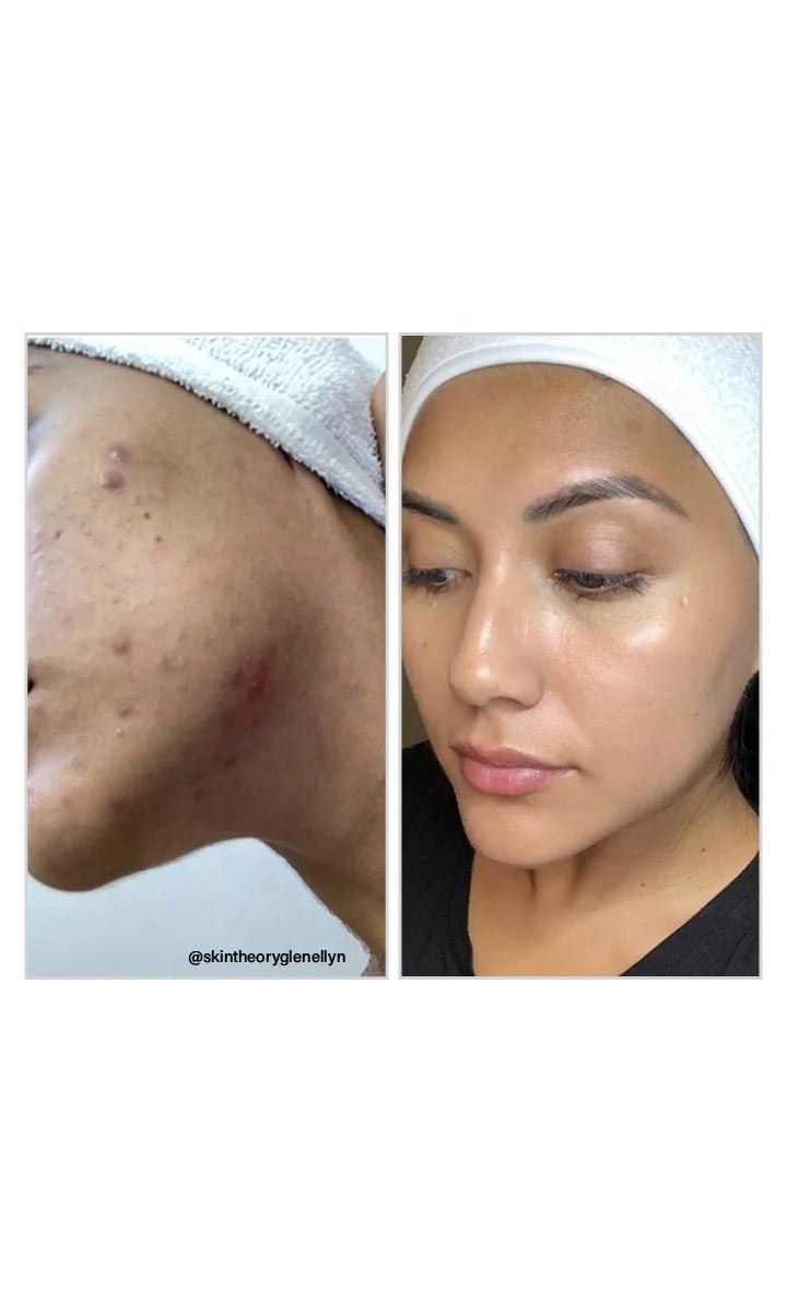 8% Mandelic Acid Serum - Amethyst Skin Clinic