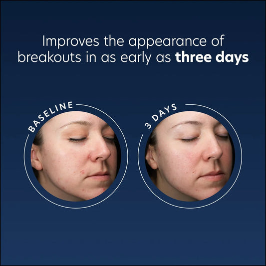 Acne Gel with OmniSome®