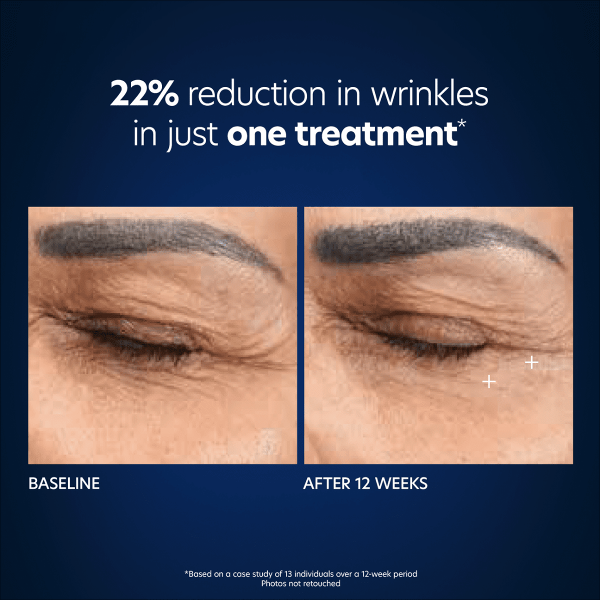 Hyaluronic Acid Microneedle Eye Patches - Amethyst Skin Clinic