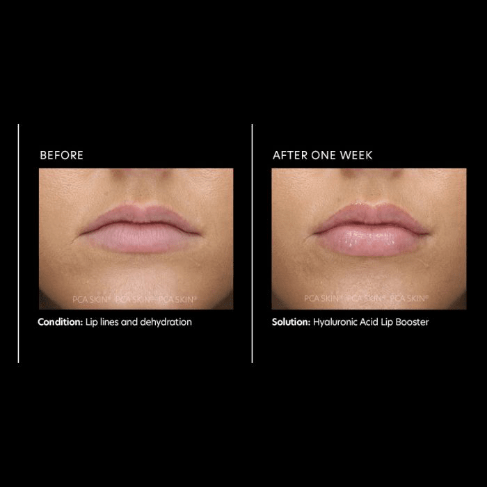 Hyaluronic Acid Lip Booster - Amethyst Skin Clinic
